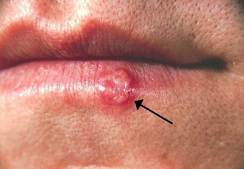 herpes labialis